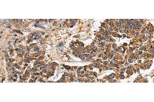 Immunohistochemistry of paraffin-embedded Human colorectal cancer tissue using GANAB Polyclonal Antibody at dilution of 1:30(x200)
