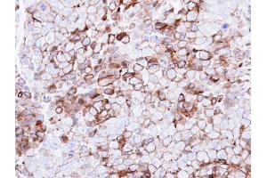 IHC-P Image Immunohistochemical analysis of paraffin-embedded CL1-0 xenograft, using GPR86, antibody at 1:500 dilution.