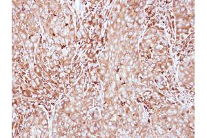 IHC-P Image Immunohistochemical analysis of paraffin-embedded A549 xenograft, using MMP3, antibody at 1:500 dilution.