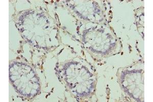 Immunohistochemistry of paraffin-embedded human colon cancer using ABIN7166715 at dilution of 1:100