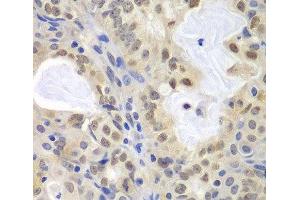 Immunohistochemistry of paraffin-embedded Human oophoroma using MCM3 Polyclonal Antibody at dilution of 1:100 (40x lens).