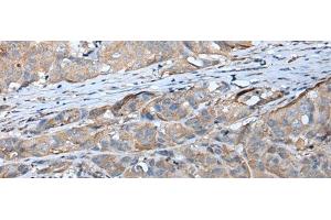 Immunohistochemistry of paraffin-embedded Human breast cancer tissue using GPC5 Polyclonal Antibody at dilution of 1:40(x200)