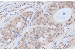 Immunohistochemistry of paraffin-embedded Human colon carcinoma using CDK9 Polyclonal Antibody at dilution of 1:100 (40x lens).