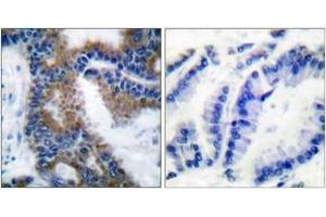 Immunohistochemistry analysis of paraffin-embedded human lung carcinoma, using CrkL (Phospho-Tyr207) Antibody.