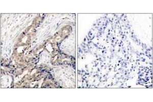 Immunohistochemistry analysis of paraffin-embedded human breast carcinoma, using Abl (Phospho-Tyr393/412) Antibody.