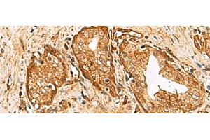 Immunohistochemistry of paraffin-embedded Human prost at e cancer tissue using DHRS2 Polyclonal Antibody at dilution of 1:55(x200)