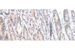 Immunohistochemistry of paraffin-embedded Human gastric cancer tissue using CALB2 Polyclonal Antibody at dilution of 1:25(x200)