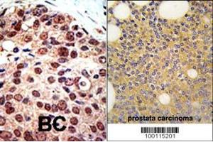 Formalin-fixed and paraffin-embedded human prostata carcinoma tissue reacted with PRMT3 Antibody (C-term) (ABIN387839 and ABIN2843941) , which was peroxidase-conjugated to the secondary antibody, followed by DAB staining.