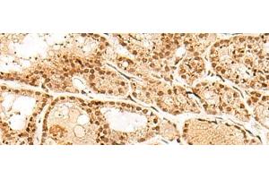 Immunohistochemistry of paraffin-embedded Human thyroid cancer tissue using POLH Polyclonal Antibody at dilution of 1:45(x200)