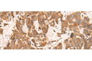 Immunohistochemistry of paraffin-embedded Human thyroid cancer tissue using NRG2 Polyclonal Antibody at dilution of 1:65(x200)