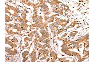 The image on the left is immunohistochemistry of paraffin-embedded Human colon cancer tissue using ABIN7190209(CELSR2 Antibody) at dilution 1/50, on the right is treated with synthetic peptide.