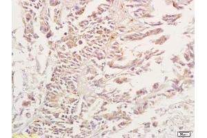 Formalin-fixed and paraffin embedded human gastric carcinoma tissue labeled with Anti-ADORA3/Adenosine A3 Receptor Polyclonal Antibody, Unconjugated (ABIN673629) at 1:200, followed by conjugation to the secondary antibody and DAB staining