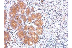 IHC-P Image CCKBR antibody [C1C2], Internal detects CCKBR protein at membrane on human colon carcinoma by immunohistochemical analysis.