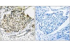 Immunohistochemistry analysis of paraffin-embedded human breast carcinoma, using IKK-gamma (Phospho-Ser31) Antibody.