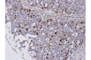 IHC-P Image Immunohistochemical analysis of paraffin-embedded human ovarian cancer, using FOXM1, antibody at 1:100 dilution.