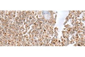 Immunohistochemistry of paraffin-embedded Human ovarian cancer tissue using GLYAT Polyclonal Antibody at dilution of 1:50(x200)