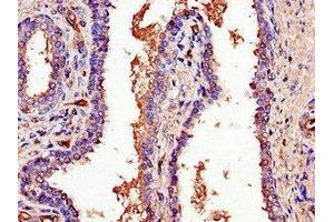 Immunohistochemistry of paraffin-embedded human prostate cancer using ABIN7164882 at dilution of 1:100