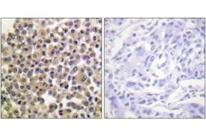 Immunohistochemistry analysis of paraffin-embedded human breast carcinoma, using p130 Cas (Phospho-Tyr249) Antibody.