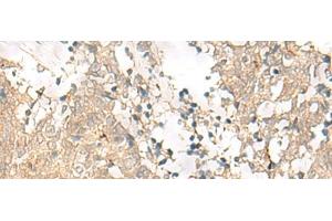 Immunohistochemistry of paraffin-embedded Human lung cancer tissue using GPSM1 Polyclonal Antibody at dilution of 1:85(x200)