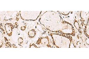 Immunohistochemistry of paraffin-embedded Human thyroid cancer tissue using ATP5O Polyclonal Antibody at dilution of 1:90(x200)