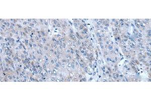 Immunohistochemistry of paraffin-embedded Human liver cancer tissue using ZIC1 Polyclonal Antibody at dilution of 1:65(x200)