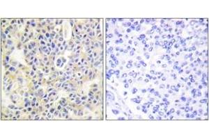 Immunohistochemistry analysis of paraffin-embedded human breast carcinoma, using PKC thet (Phospho-Ser695) Antibody.