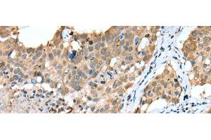 Immunohistochemistry of paraffin-embedded Human lung cancer tissue using SPRY4 Polyclonal Antibody at dilution of 1:25(x200)