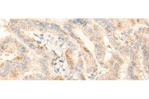 Immunohistochemistry of paraffin-embedded Human thyroid cancer tissue using BZW2 Polyclonal Antibody at dilution of 1:25(x200)