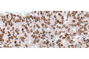 Immunohistochemistry of paraffin-embedded Human colorectal cancer tissue using XAB2 Polyclonal Antibody at dilution of 1:25(x200)