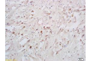 Formalin-fixed and paraffin embedded human lung carcinoma labeled with Rabbit Anti phospho-p53BP1(Ser25/29) Polyclonal Antibody, Unconjugated (ABIN682993) at 1:200 followed by conjugation to the secondary antibody and DAB staining