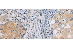 Immunohistochemistry of paraffin-embedded Human breast cancer tissue using GBA Polyclonal Antibody at dilution of 1:55(x200)