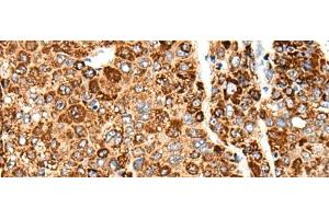 Immunohistochemistry of paraffin-embedded Human liver cancer tissue using CACNG5 Polyclonal Antibody at dilution of 1:50(x200)