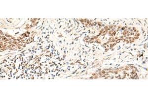 Immunohistochemistry of paraffin-embedded Human esophagus cancer tissue using HOXD9 Polyclonal Antibody at dilution of 1:30(x200)