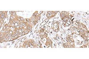 Immunohistochemistry of paraffin-embedded Human gastric cancer tissue using TEAD2 Polyclonal Antibody at dilution of 1:60(x200)