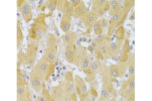 Immunohistochemistry of paraffin-embedded Human liver cancer using Slug Polyclonal Antibody at dilution of 1:100 (40x lens).