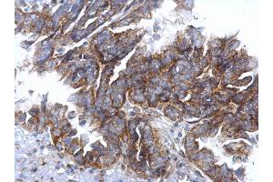IHC-P Image CCR3 antibody [C2C3], C-term detects CCR3 protein at cytosol on human ovarian carcinoma by immunohistochemical analysis.