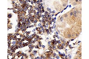 Immunohistochemistry analysis of paraffin-embedded human stomach cancer using CD192 Polyclonal Antibody at dilution of 1:300.