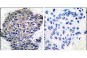 Immunohistochemistry analysis of paraffin-embedded human breast carcinoma, using Filamin A (Phospho-Ser2152) Antibody.