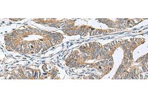 Immunohistochemistry of paraffin-embedded Human colorectal cancer tissue using DPY19L3 Polyclonal Antibody at dilution of 1:120(x200)