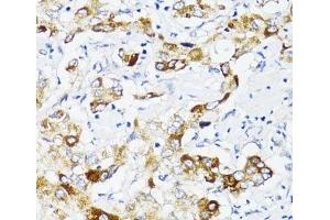 Immunohistochemistry of paraffin-embedded Human liver cancer using Fibronectin Polyclonal Antibody at dilution of 1:100 (40x lens).