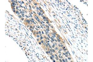 The image on the left is immunohistochemistry of paraffin-embedded Human esophagus cancer tissue using ABIN7193036(VWCE Antibody) at dilution 1/30, on the right is treated with synthetic peptide.