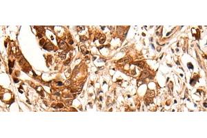 Immunohistochemistry of paraffin-embedded Human gastric cancer tissue using HOXD8 Polyclonal Antibody at dilution of 1:40(x200)