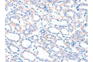 The image on the left is immunohistochemistry of paraffin-embedded Human thyroid cancer tissue using ABIN7128186(ACSM5 Antibody) at dilution 1/35, on the right is treated with fusion protein.