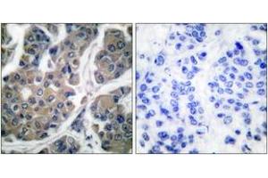 Immunohistochemistry analysis of paraffin-embedded human breast carcinoma, using eEF2 (Phospho-Thr56) Antibody.