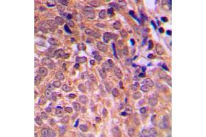 Immunohistochemical analysis of APC staining in human breast cancer formalin fixed paraffin embedded tissue section.