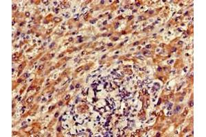 Immunohistochemistry of paraffin-embedded human liver cancer using ABIN7165354 at dilution of 1:100
