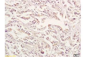 Formalin-fixed and paraffin embedded human gastric carcinoma labeled with Anti-GPA33 Polyclonal Antibody, Unconjugated (ABIN673644) at 1:200 followed by conjugation to the secondary antibody and DAB staining.