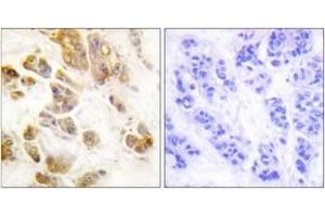 Immunohistochemistry analysis of paraffin-embedded human breast carcinoma, using CaMK1-alpha (Phospho-Thr177) Antibody.