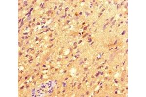Immunohistochemistry of paraffin-embedded human glioma using ABIN7147801 at dilution of 1:100