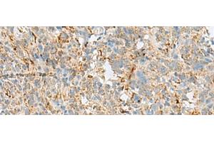 Immunohistochemistry of paraffin-embedded Human cervical cancer tissue using VDAC3 Polyclonal Antibody at dilution of 1:30(x200)